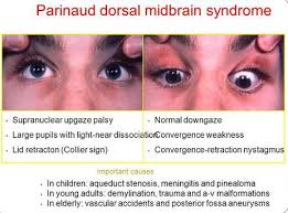 Image Result For Parinaud Syndrome Compras Cosas Para Comprar