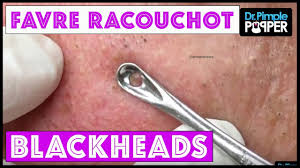 A blackhead is also called an open comedo (single for comedone), and it is a clogged pore in the skin that is open to the air. Favre Racouchot Blackheads In Sigh Man Blackheads Pimples Acne