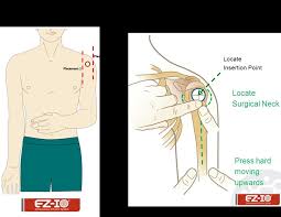 Image result for Intraosseous Access