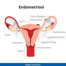 Perché la diagnosi richiede tanto tempo. Endometriosi Cos E Cause Sintomi E Cura