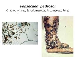 The type species, fonsecaea pedrosoi, is associated with the disease chromoblastomycosis. Piedraia Hortae Capnodiales Dothideomycetes Ascomycota Fungi Trichosporon Beigelii