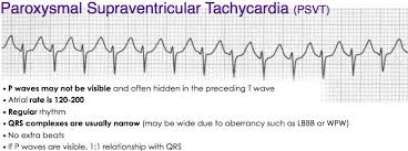 Rosh Review Emergency Medicine Arrythmias Cardiac Nursing