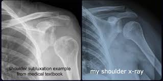 Image result for Shoulder Subluxation