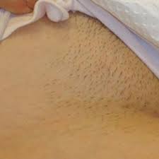 Mlay ipl hair removal system. Laser Hair Removal Kuala Lumpur Malaysia Cost Reviews Benefits Nexus Cllinic