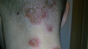 Rash 22 Common Skin Rashes Pictures Causes And Treatment