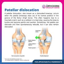 Image result for Patellar Dislocation