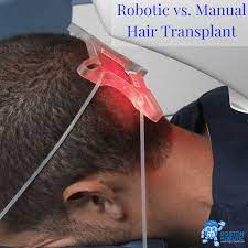 Robotic Vs Manual Hair Transplant Robohair Boston