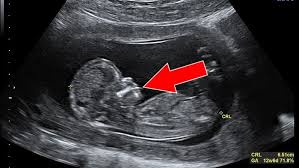 Beim Ultraschall Erfahrt Eine Junge Amerikanerin Dass Ihr Baby Herzkrank Ist