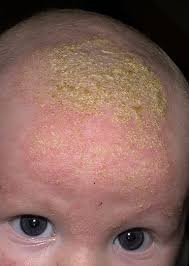 Image result for yellow scabs on the face in children