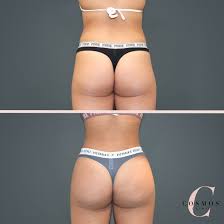 These averages are based on the surgeon fees only — you may still have to consider other costs, such. Brazilian Butt Lift Sydney Buttock Augmentation Sydney