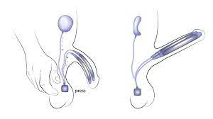 Protese Peniana Dr Marcelo Thiel