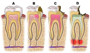Image result for Periapical Block