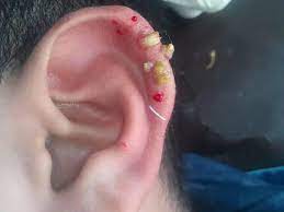 They look like a freckle but they're usually larger, darker and stand out more than a normal freckle. Skin Cancer And Rashes Cancerous And Precancerous Lesions