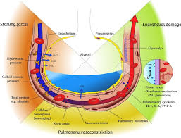 Image result for Transfusion Associated Circulatory Overload