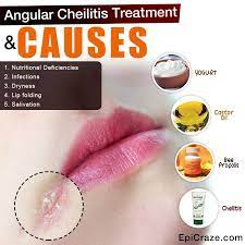 Angular Cheilitis Treatment And Causes Cracked Corners Of Mouth Treatment The Cure