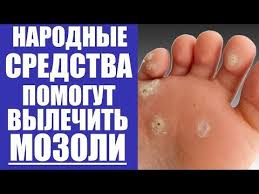как избавиться от мозолей на пальцах ног народными средствами Youtube Youtube