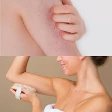How Can I Get Rid Of Chicken Skin Keratosis Pilaris Keratosis Pilaris Treatment Itchy Skin Remedy