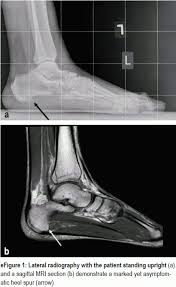 Familiarity with the normal anatomy of the plantar tendons and its appearance at magnetic resonance (mr) imaging and ultrasonography (us) is essential for recognizing plantar tendon disorders. Pain On The Plantar Surface Of The Foot 08 02 2019