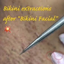 Just pull the hair off your skin and cut off whatever goes over your fingers. Dont Suffer From Ingrown Hairs And Hyperpigmentation Get Your Bikini Facial Thewaxden Ingrownhairs Extra Ingrown Hair Ingrown Hair Armpit Hyperpigmentation