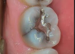 A periapical tooth abscess occurs when bacteria invade the dental pulp — the innermost part of the tooth that contains blood vessels, nerves and connective tissue. How To Classify The 5 Types Of Cracked Teeth Spear Education