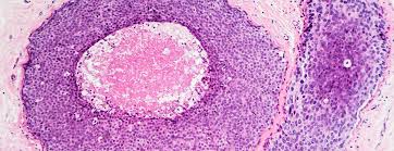 A biopsy is the removal of a sample of tissue from the body for examination. Biopsy For Breast Cancer Diagnosis Surgical Breast Biopsy Ucsf Health