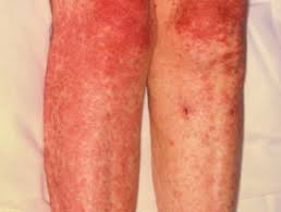 Group of the diseases called pigment hepatoses: Sjs Ten Images Dermnet Nz