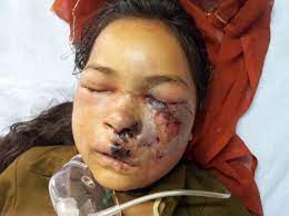 Infection with the fungus zygomycetes causes mucormycosis (zygomycosis). Rhinocerebral Mucormycosis In A Patient With Type 1 Diabetes Presenting As Toothache A Case Report From Himalayan Region Of India Bmj Case Reports