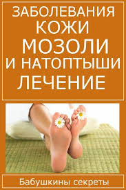 как избавиться от мозолей на ступнях в домашних условиях Babushkiny Recepty Lechenie Mozolej V Domashnih Usloviyah Zdorove Zdorove Detej Zdorove Ot Prirody