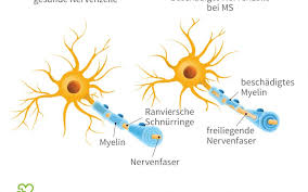 At immunsystemet angriper kroppens egne celler. Multiple Sklerose Myelinreparatur Als Therapie Ruckt In Griffweite Onmeda De