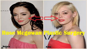 Rose mcgowan plastic surgery before and after facelift lip injection and breast implant photos celebrity weight loss and celebrity . Rose Mcgowan Plastic Surgery Before And After Photo 2013 2014