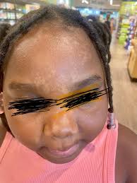 Is Wendy's mom using lightening cream or does she have vitiligo?