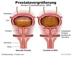 Explains prostate problems including prostatitis and benign prostatic hyperplasia. Prostatavergrosserung Ihre Apotheke Informiert