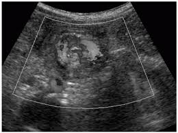 Image result for Midgut Volvulus