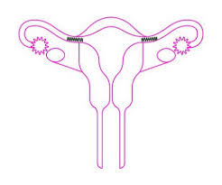Voici quelques points à considérer avant de prendre cette grande décision. A Quoi Dois Je M Attendre Si Je Fais Le Choix De La Ligature Des Trompes Guide Contraceptions Org