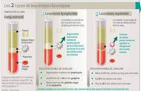 Leucémie lymphoïde chronique leucémie à prolymphocytes leucé durable de la maladie o sujet agé : Leucemies Chroniques La Revolution Du Pronostic Vital