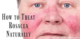 how to treat rosacea naturally for