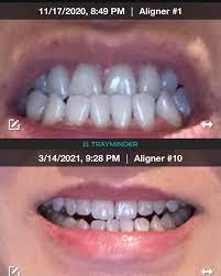 Correct your underbite with braces braces are used to correct mild to severe. 11 86 My Underbite Treatment Diary Invisalign
