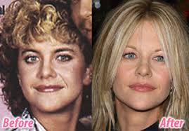After examining photos of the bubbly blonde, new york plastic surgeon dr. Megryan Meg Ryan Celebrity Plastic Surgery Before And Afte Flickr