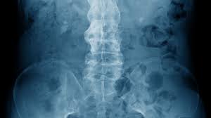 Image result for XRay Changes in Rheumatic Conditions