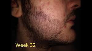 Minoxidil is used for alopecia, hypertension etc. 5 Minoxidil Beard Journey Before And After 32 Weeks Youtube