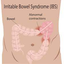 Symptoms And Treatment Of Irritable Bowel Syndrome Reflux Stomach Pain Ulcers Edward White