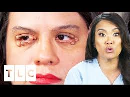 Sandra lee's offered no shortage of juicy pimple popping content. Dr Lee Removes Numerous Cysts From Woman S Eyelids Dr Pimple Popper Youtube