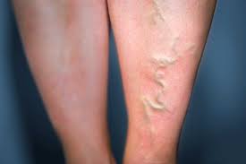 Certain conditions that change how your blood circulates can increase. Thrombose Ursachen Symptome Behandlung Prognose
