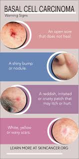 Pathological elements on the skin and mucous membranes, different from normal skin (mucous. Pin On Cancer