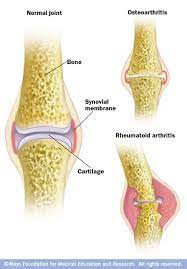 Osteoarthritis Vs Rheumatoid Arthritis Rheumatoid Arthritis Symptoms Rheumatoid Arthritis Osteoarthritis Vs Rheumatoid Arthritis