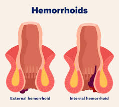Image result for hemoroid human