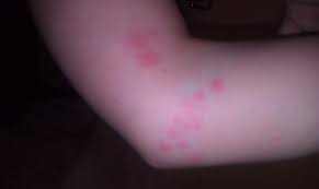 Bed bug bites can easily be distinguished as they form red spotty lines or clusters on the skin, unlike the mosquito. How To Handle Bed Bug Bites On Kids Dengarden