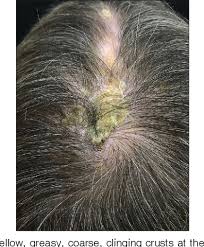 Pityriasis amiantacea, also known as pseudotinea amiantacea, is a clinical syndrome which affects the scalp, having a reaction pattern reported to occur in several inflammatory dermatoses. Trigeminal Trophic Syndrome Simulating Pityriasis Amiantacea Semantic Scholar