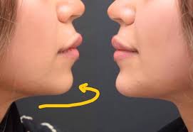 شاهد صور قبل وبعد و احصل على استشارة مجانية وعرض سعر. ØªÙ‚Ø¯ÙŠÙ… Ùˆ Ø§Ù„Ø¯ÙƒØªÙˆØ± Ù…Ø­Ù…Ø¯ Ø§Ù„Ø³ÙˆÙŠØ·ÙŠ Medical Beauty Center Ø§Ù„Ù…Ø±ÙƒØ² Ø§Ù„Ø·Ø¨ÙŠ Ø§Ù„ØªØ¬Ù…ÙŠÙ„ÙŠ Mbc Facebook