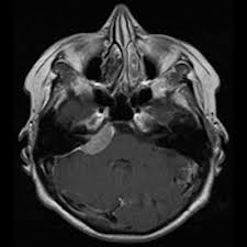 Image result for Incidental Imaging Finding